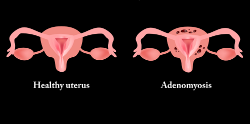 Độ dày niêm mạc tử cung và ảnh hưởng tới khả năng thụ thai@|dày nội mạc tử cung là gì@|https://vinmec-prod.s3.amazonaws.com/images/20190615_041417_495182_niem_mac_tu_cung_da.max-1800×1800.jpg@|0